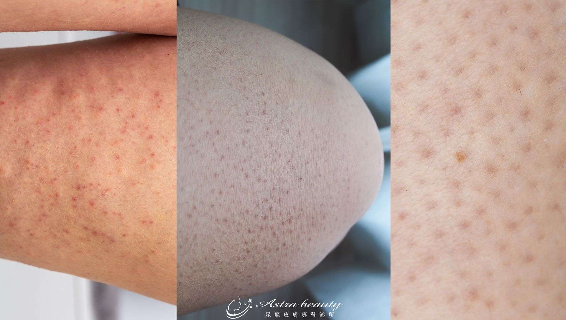 毛孔角化症症狀