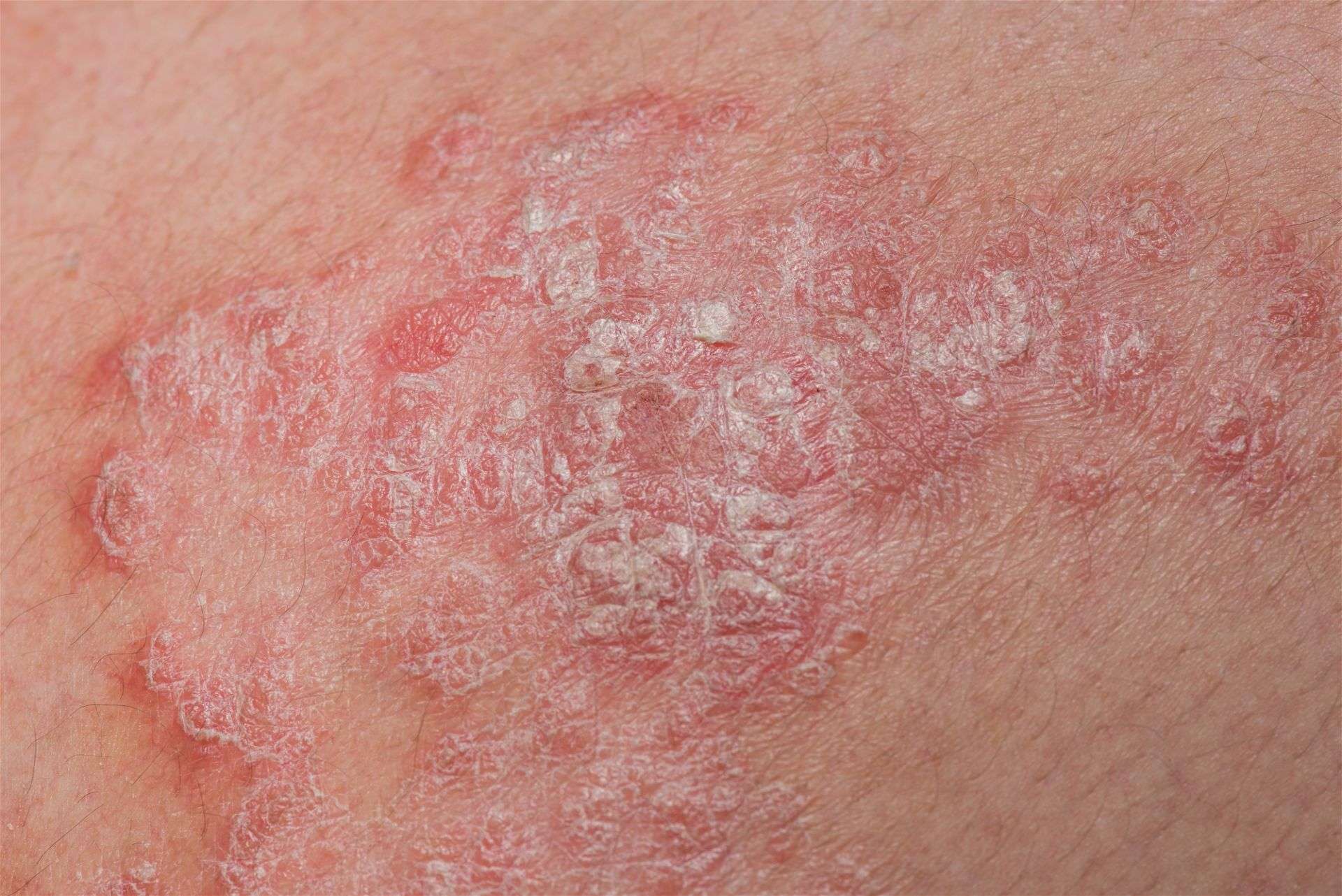 尋常型乾癬(Plaque Psoriasis)