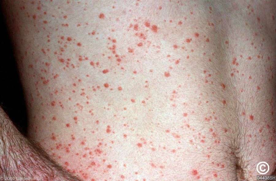 點滴型乾癬(Guttate Psoriasis)