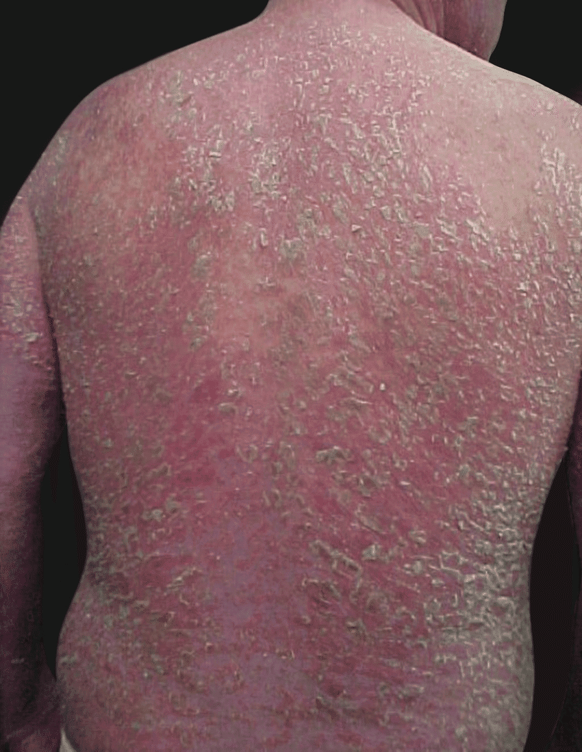 紅皮症型乾癬(Erythrodermic Psoriasis)