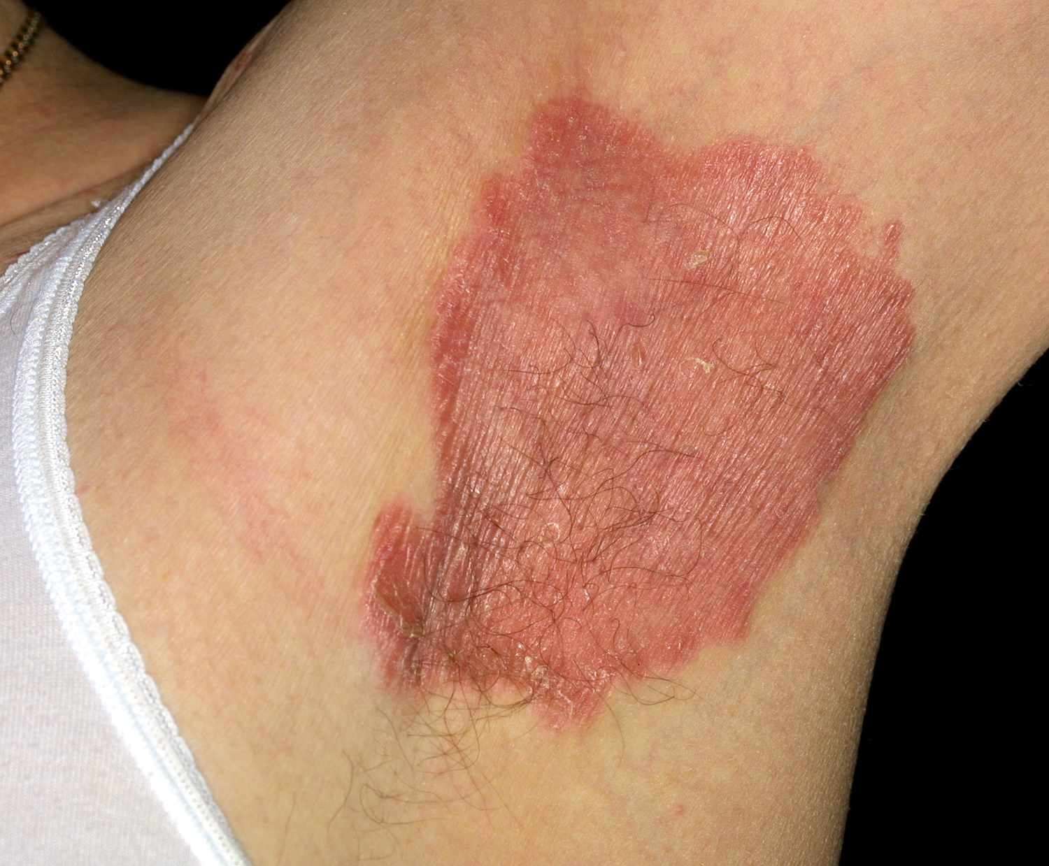 逆行性乾癬(Inverse Psoriasis)