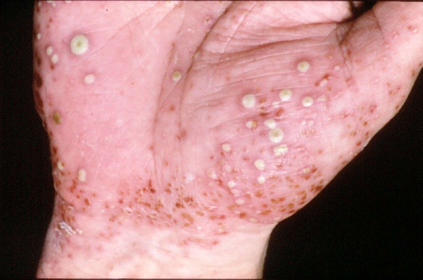 膿皰型乾癬（Pustular Psoriasis）