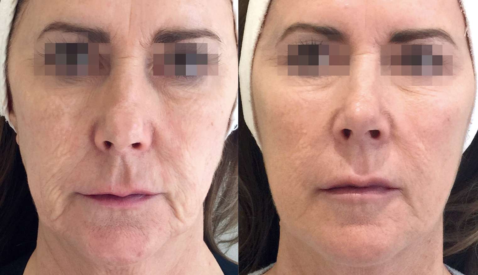 Profhilo逆時針治療案例