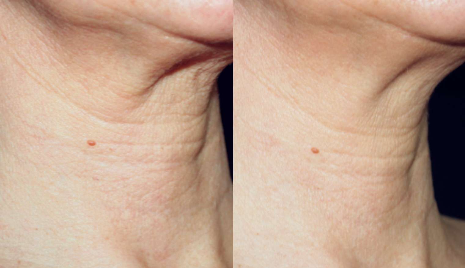 Profhilo逆時針治療案例