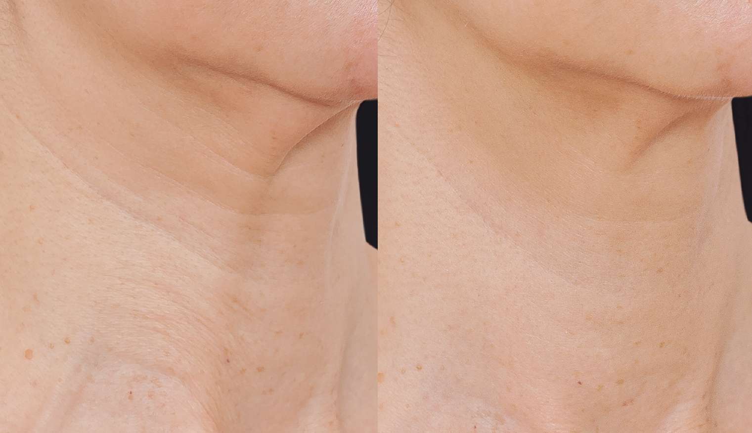 Profhilo逆時針脖紋治療案例