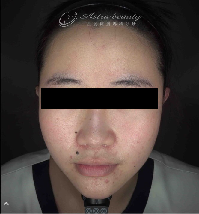 海芙音波媚必提案例術前