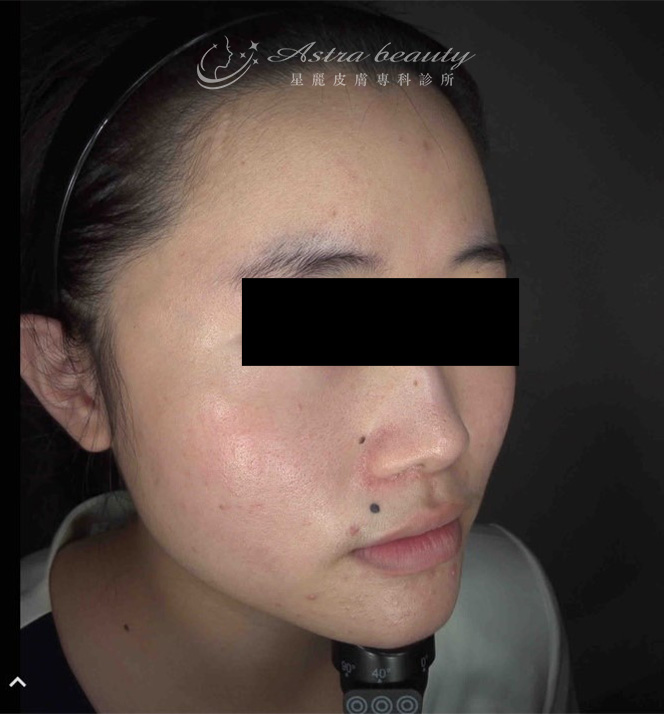 海芙音波媚必提案例術前