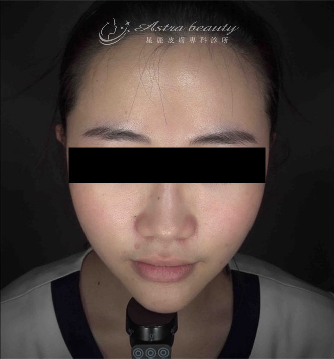 海芙音波媚必提案例術後