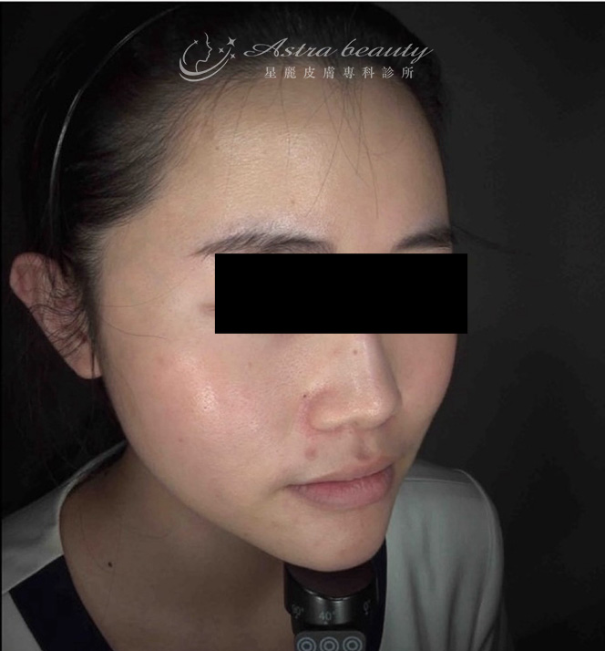 海芙音波媚必提案例術前