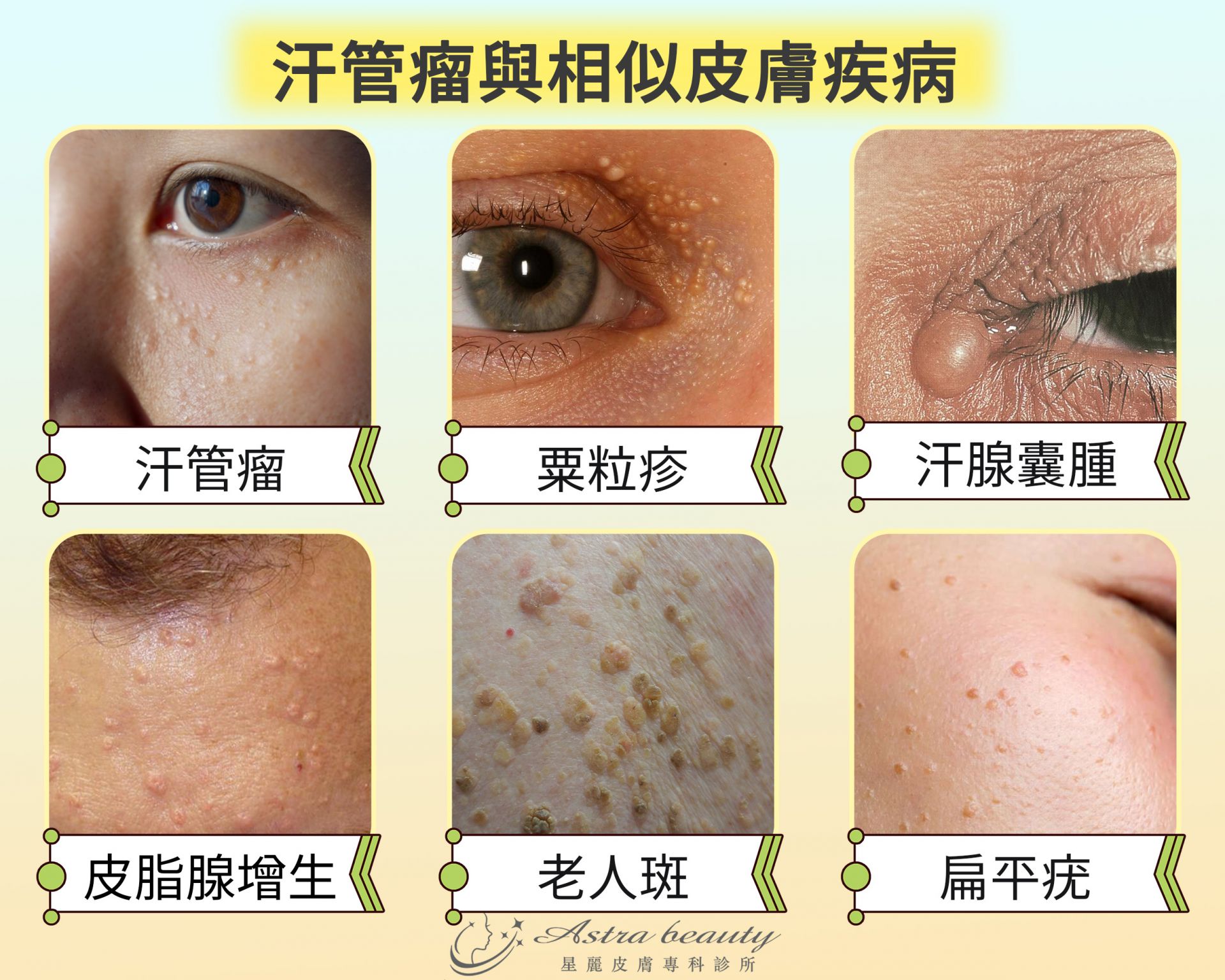 汗管瘤容易與哪些皮膚疾病搞混呢？