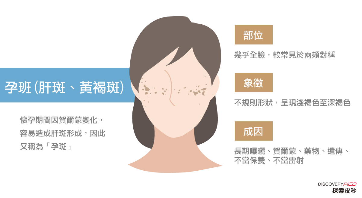 肝斑治療方式-臉