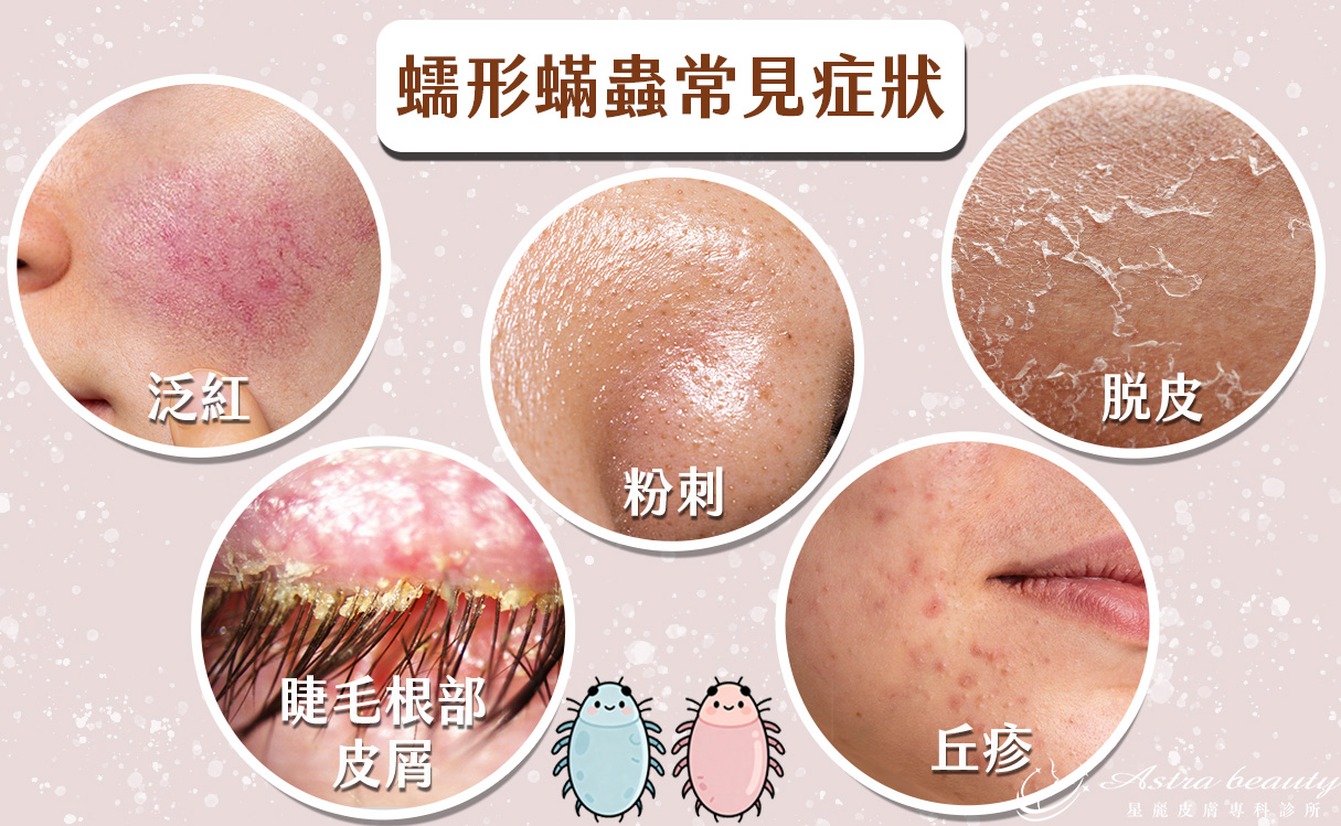 蠕形蟎蟲常見症狀