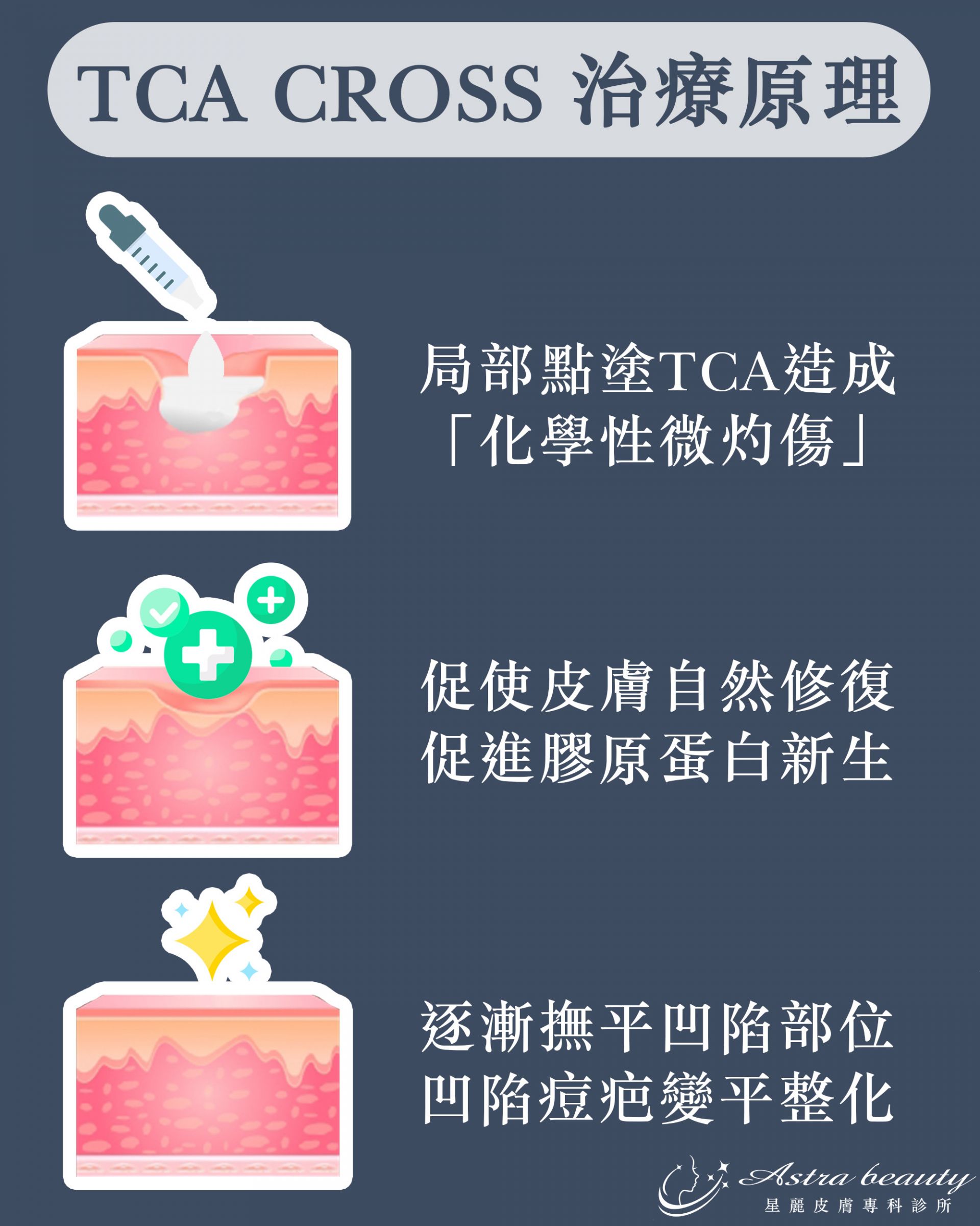 TCA CROSS 治療原理