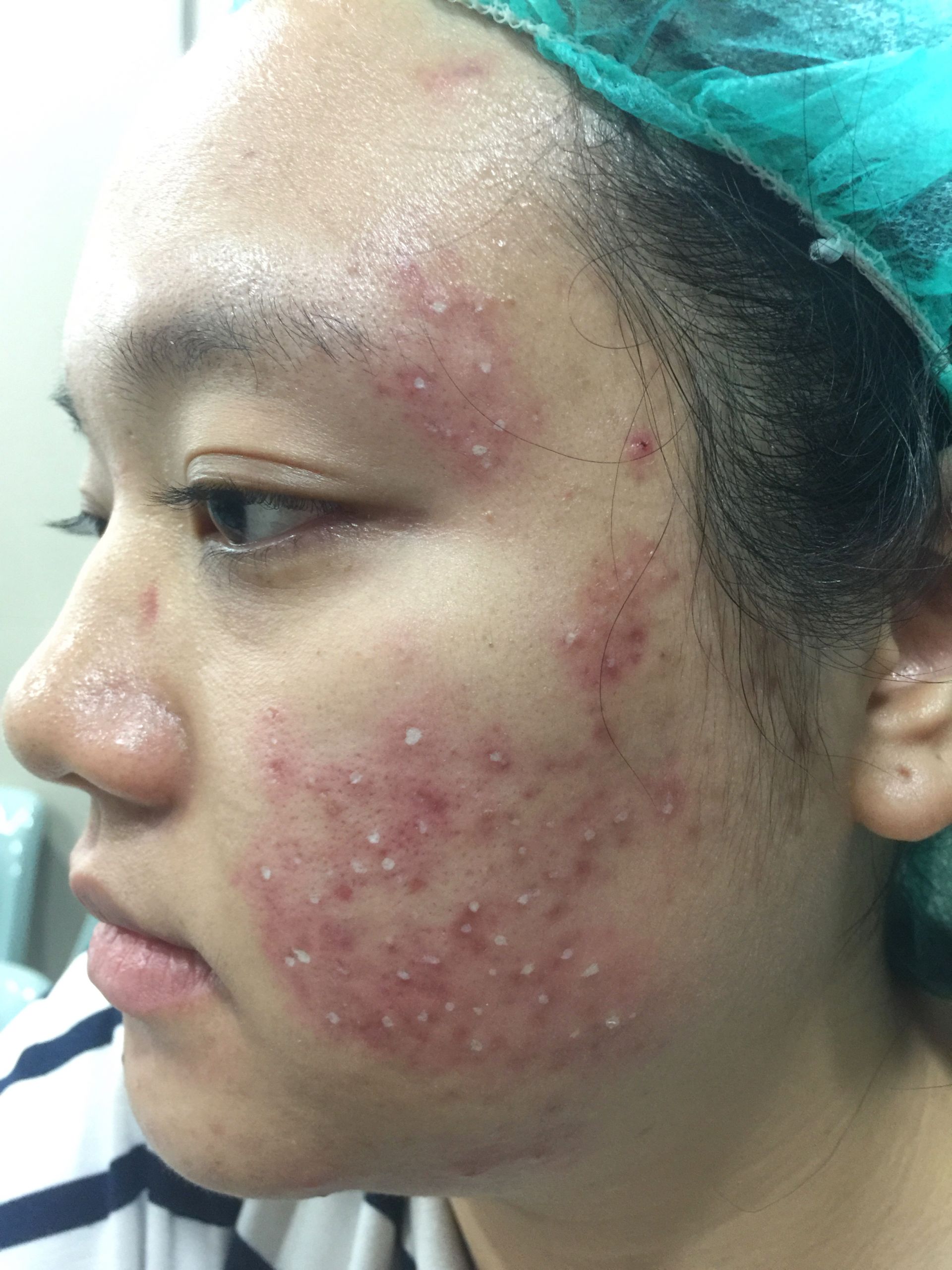 TCA CROSS治療優勢