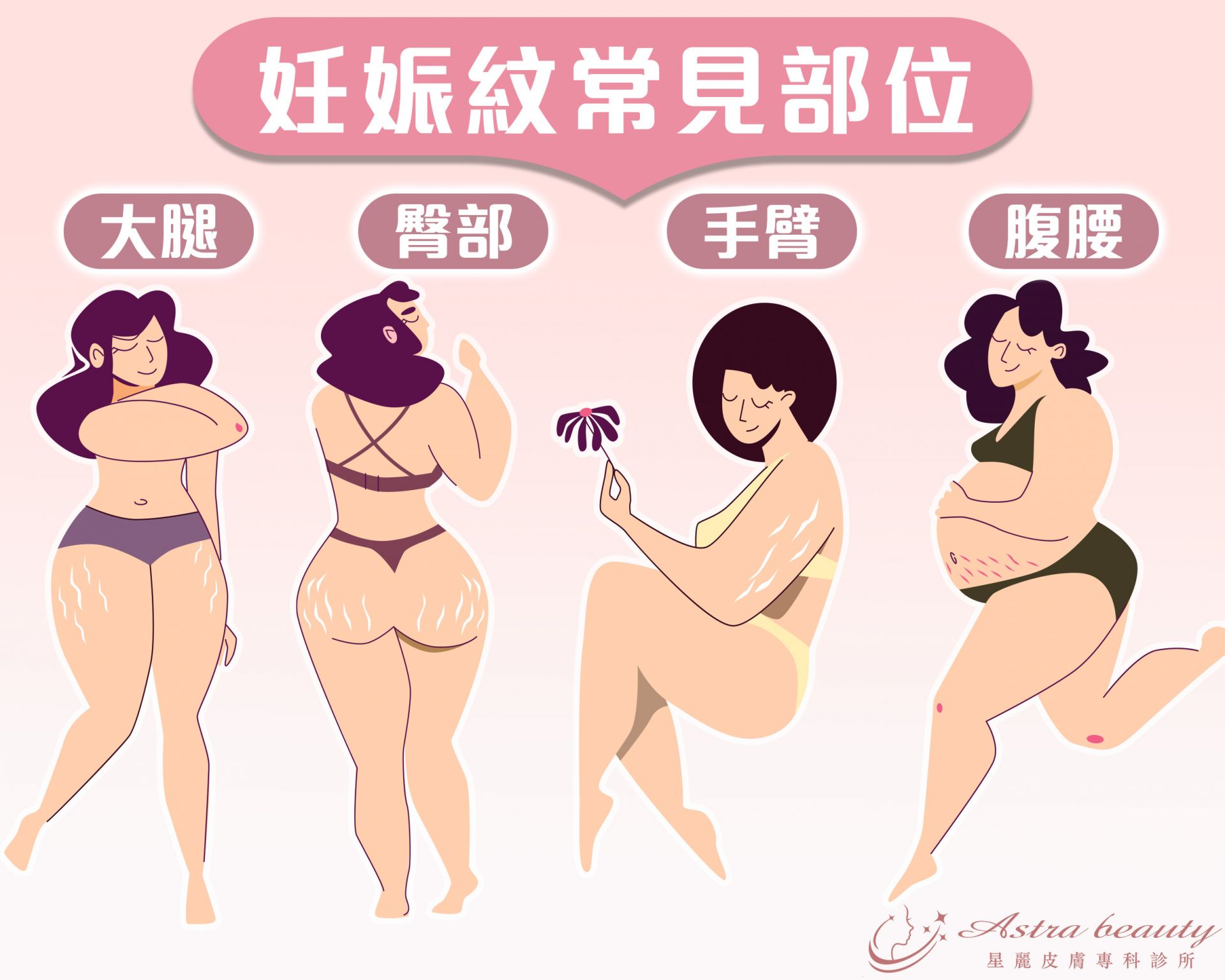 妊娠紋常見部位