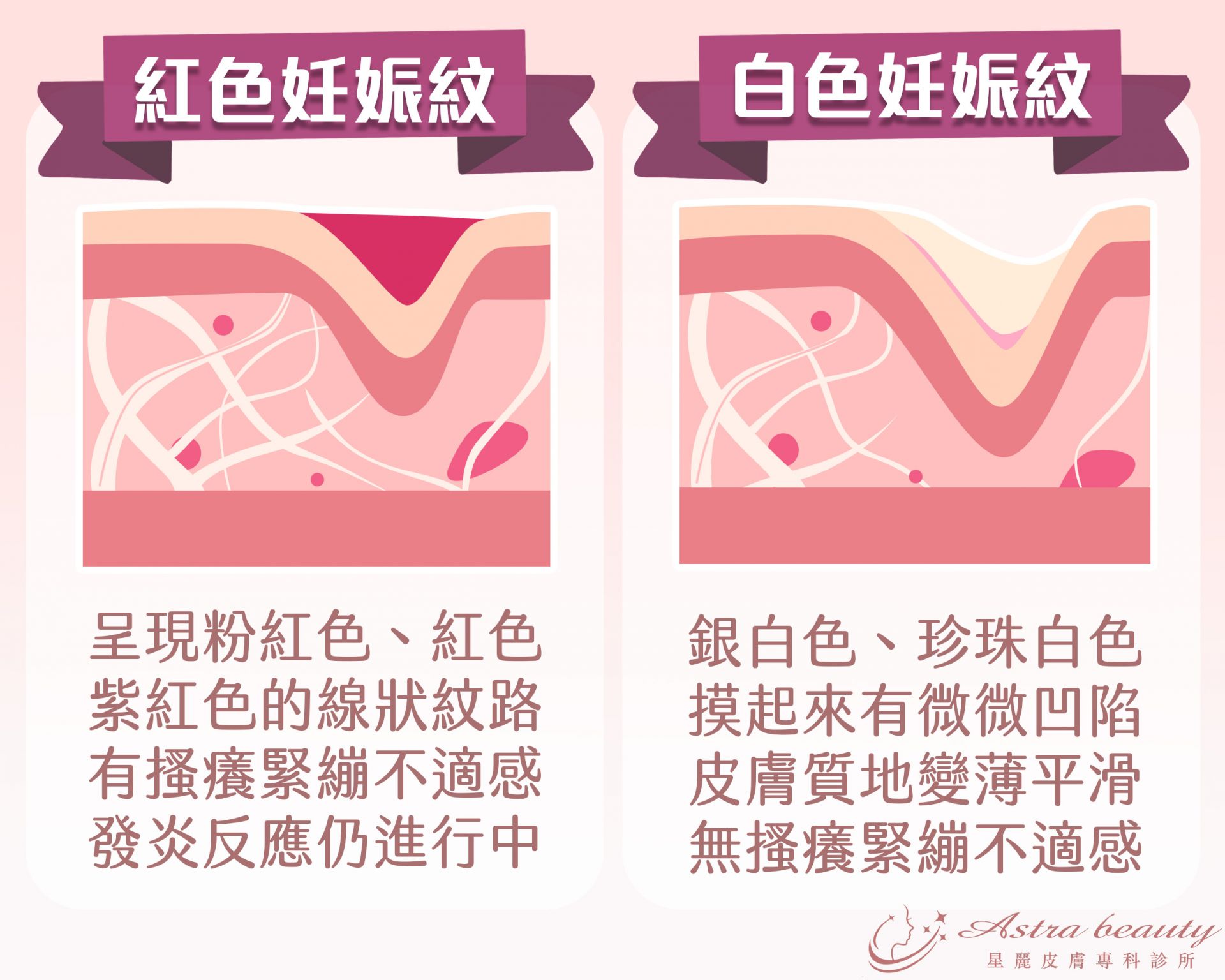 紅色妊娠紋 白色妊娠紋