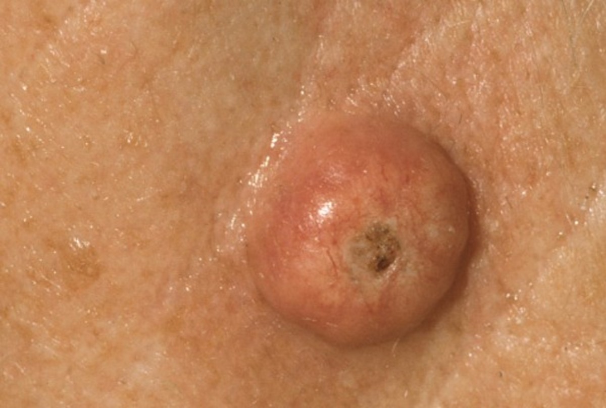 角化棘皮瘤(Keratoacanthoma, KA)