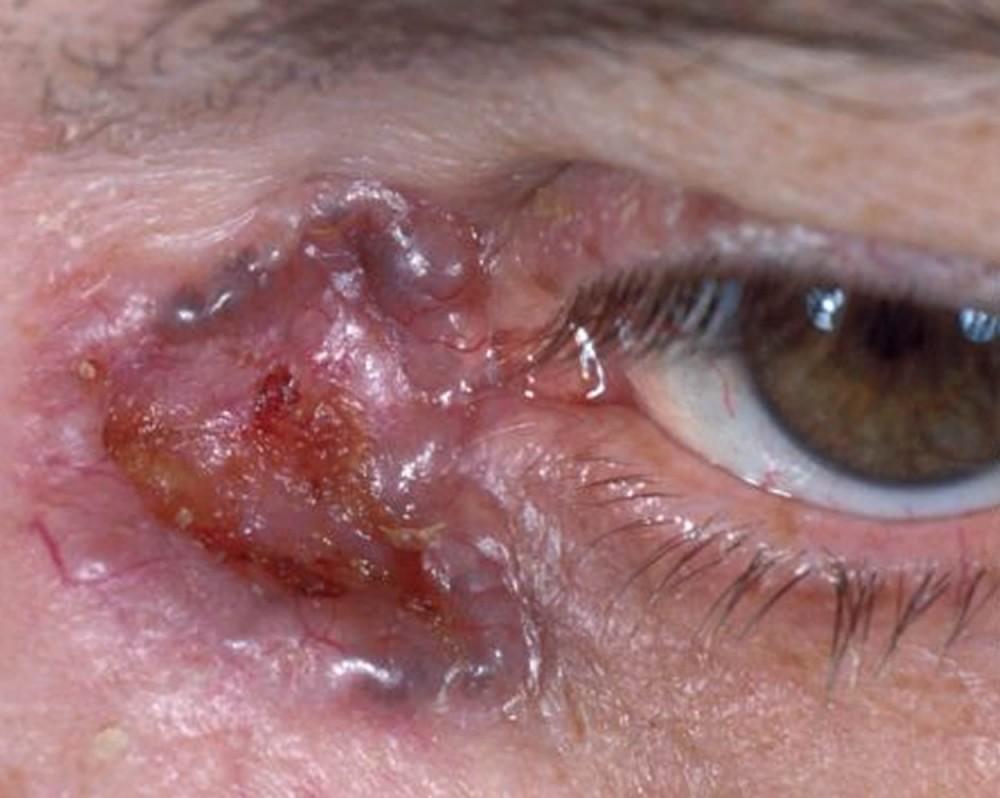 基底細胞癌（Basal Cell Carcinoma）