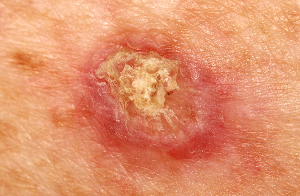 鱗狀細胞癌 ( Squamous Cell Carcinoma, SCC）