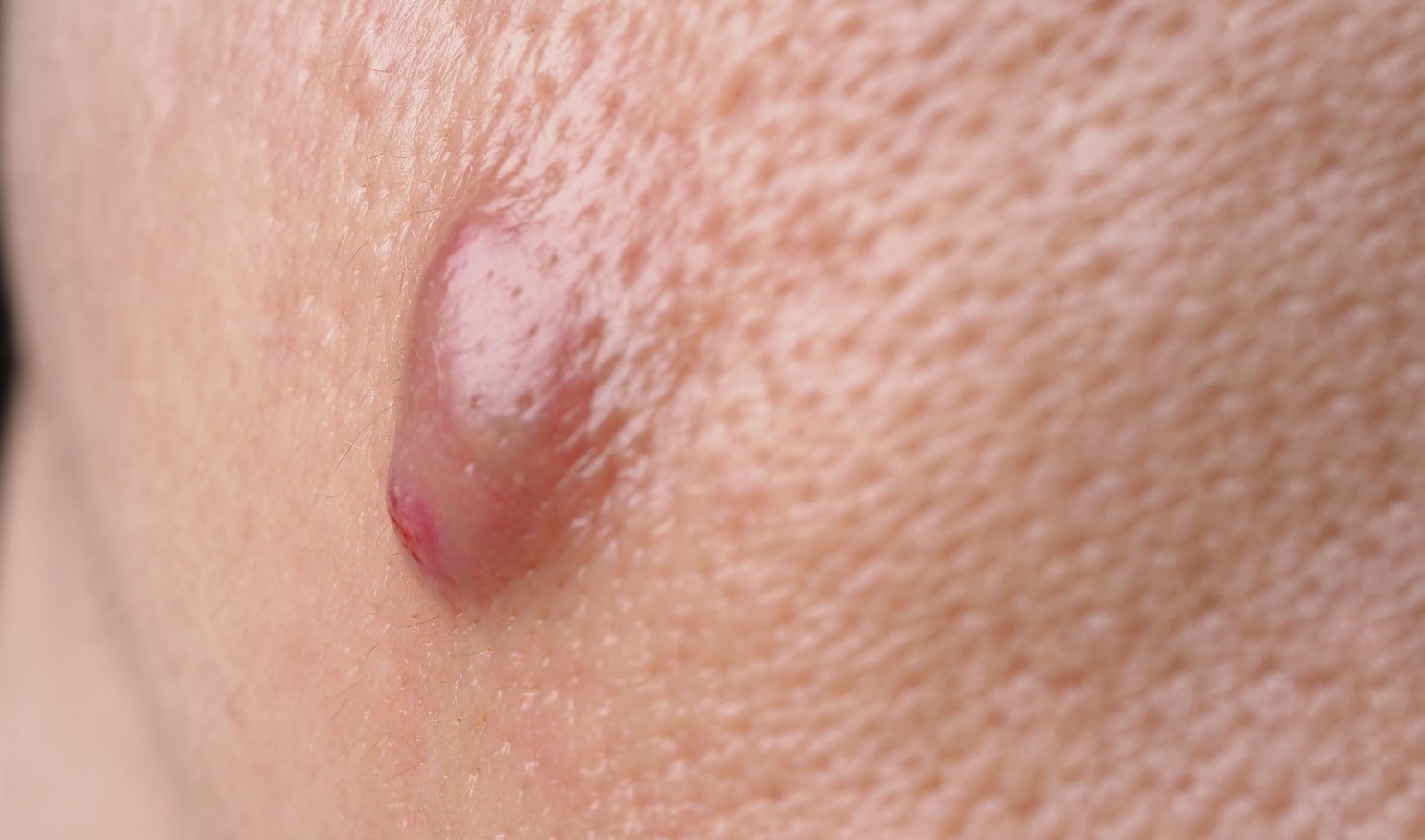 表皮囊腫（Sebaceous cyst）
