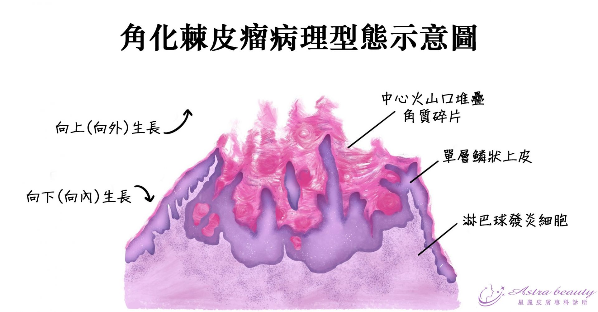 角化棘皮瘤切片病理型態示意圖