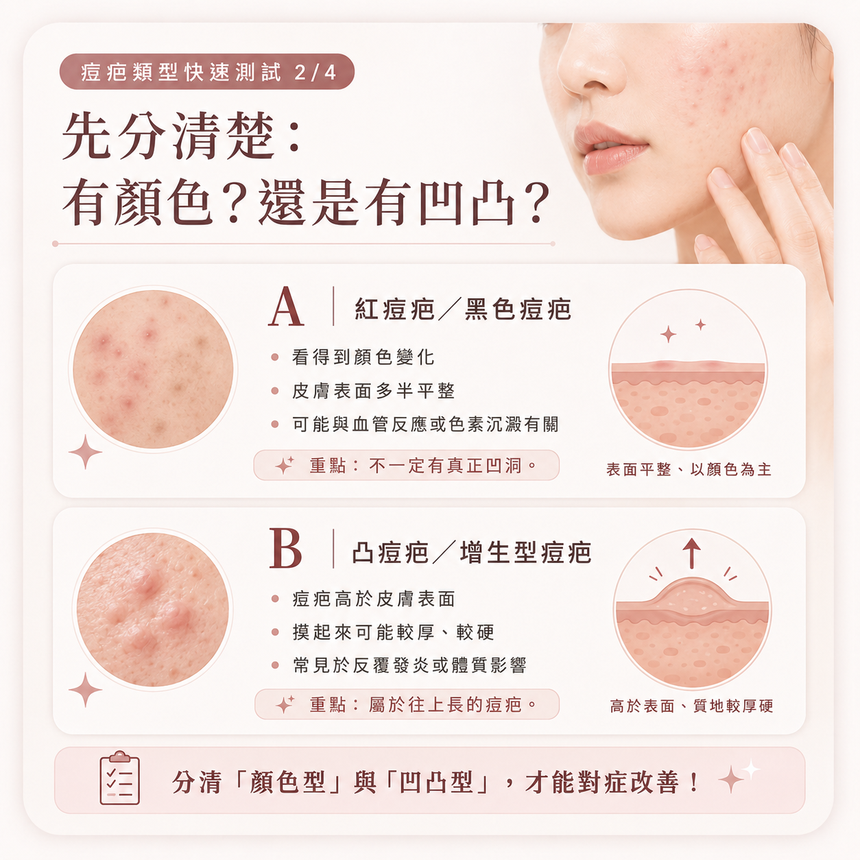 紅痘疤、黑色痘疤與凸痘疤的分辨方式