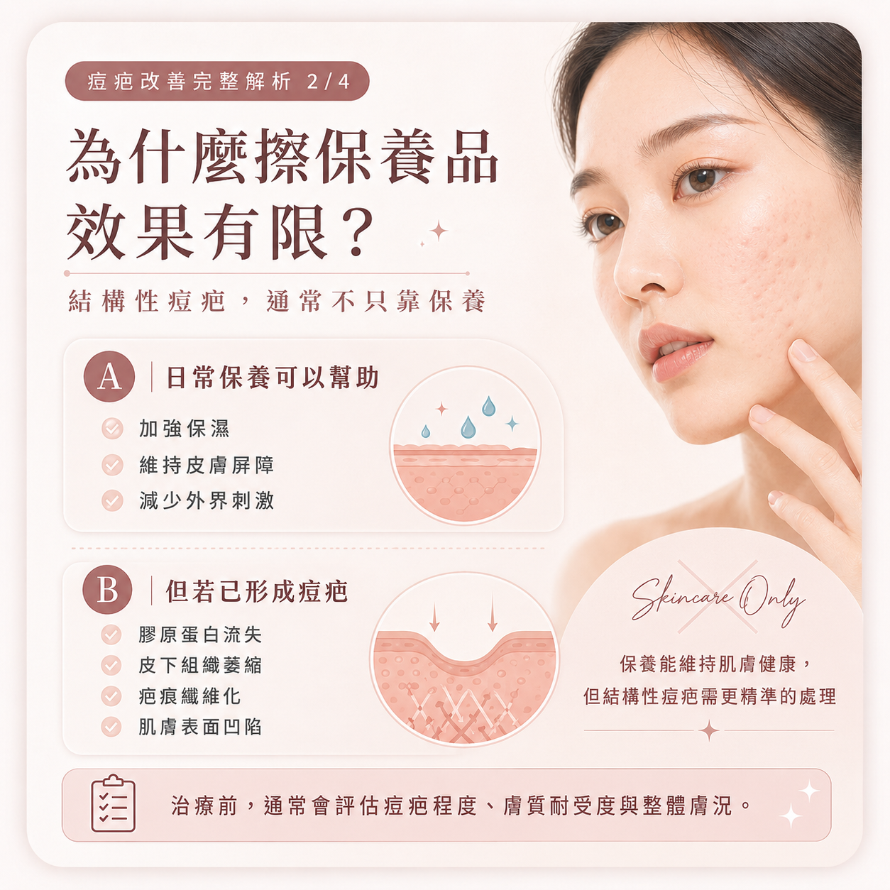 痘疤治療重點圖卡 2