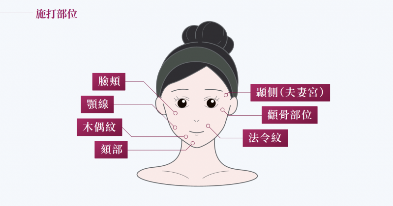 Sculptra4D舒顏萃 童顏針 童妍針 膠原蛋白增生